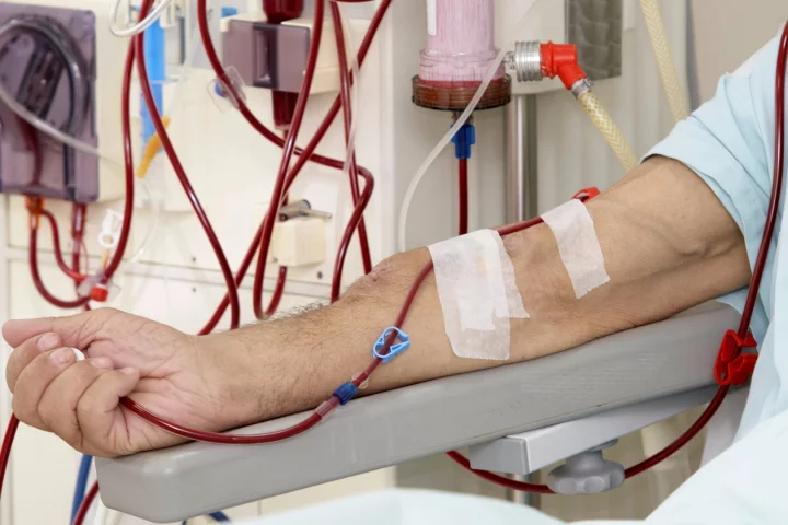 A team of MIT engineers has potentially revolutionized the process of dialysis by creating a new dialysis membrane from graphene