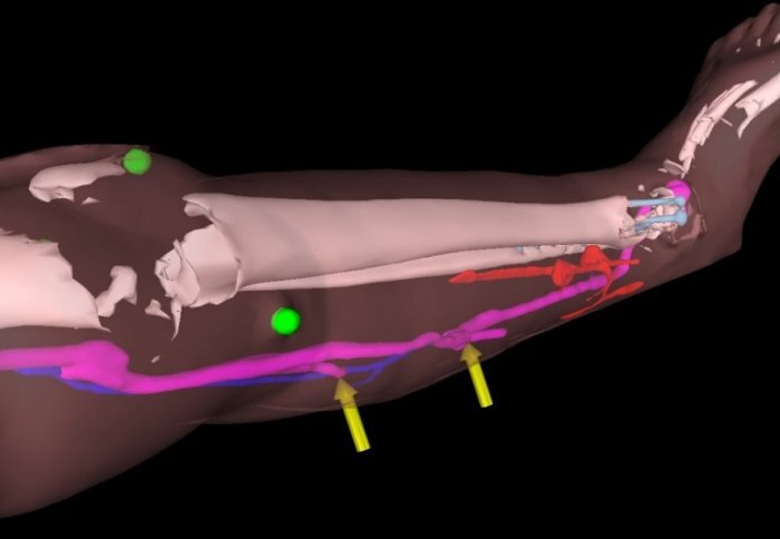 A view of a patient's leg, with the CT scan image overlaid