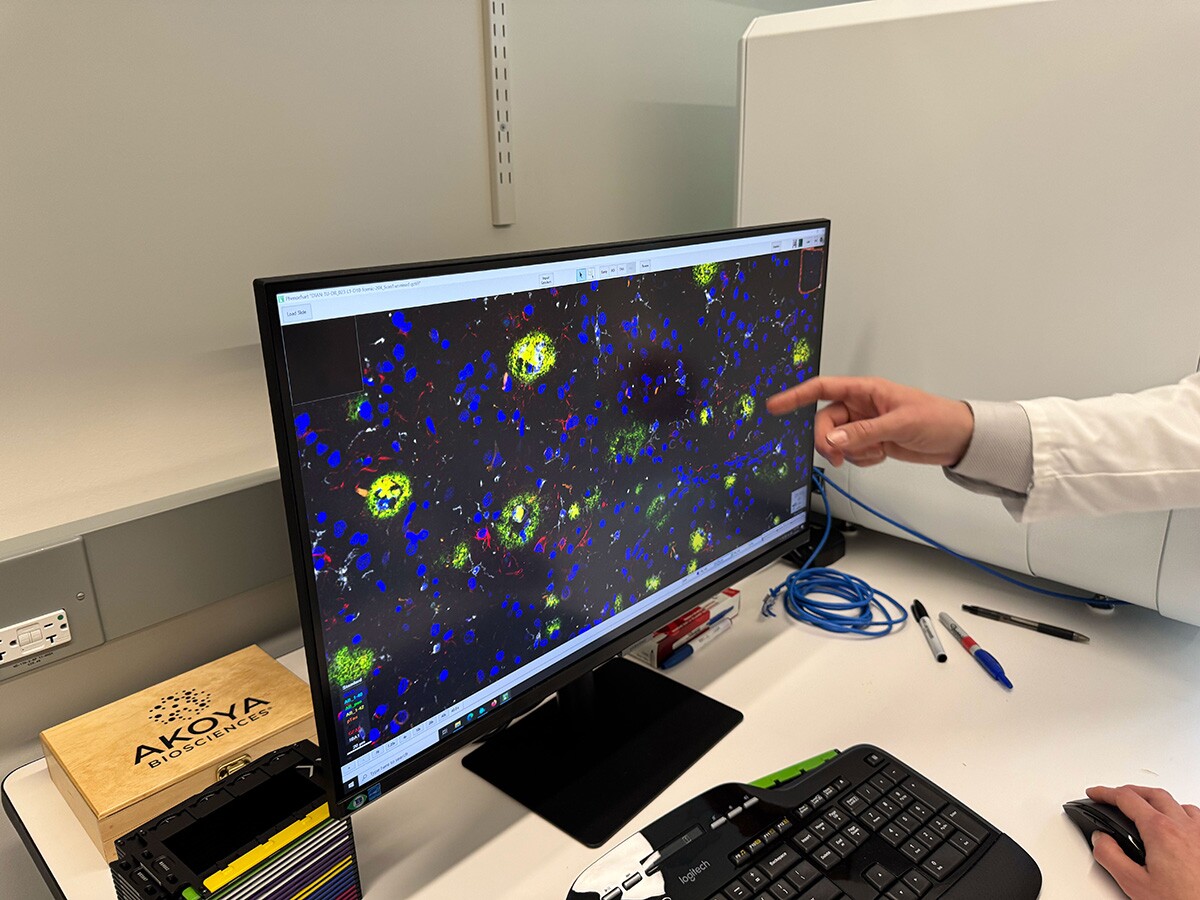 A computer image of human brain tissue with Alzheimer's Disease that had been treated with amyloid-beta immunization