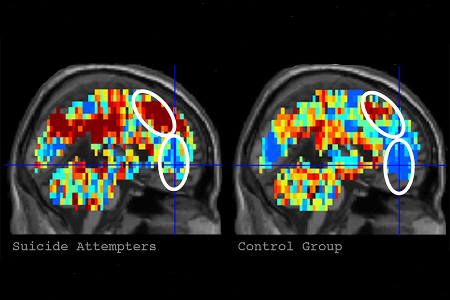 Using fMRI the researcher's successfully identified those subjects with suicidal tendencies