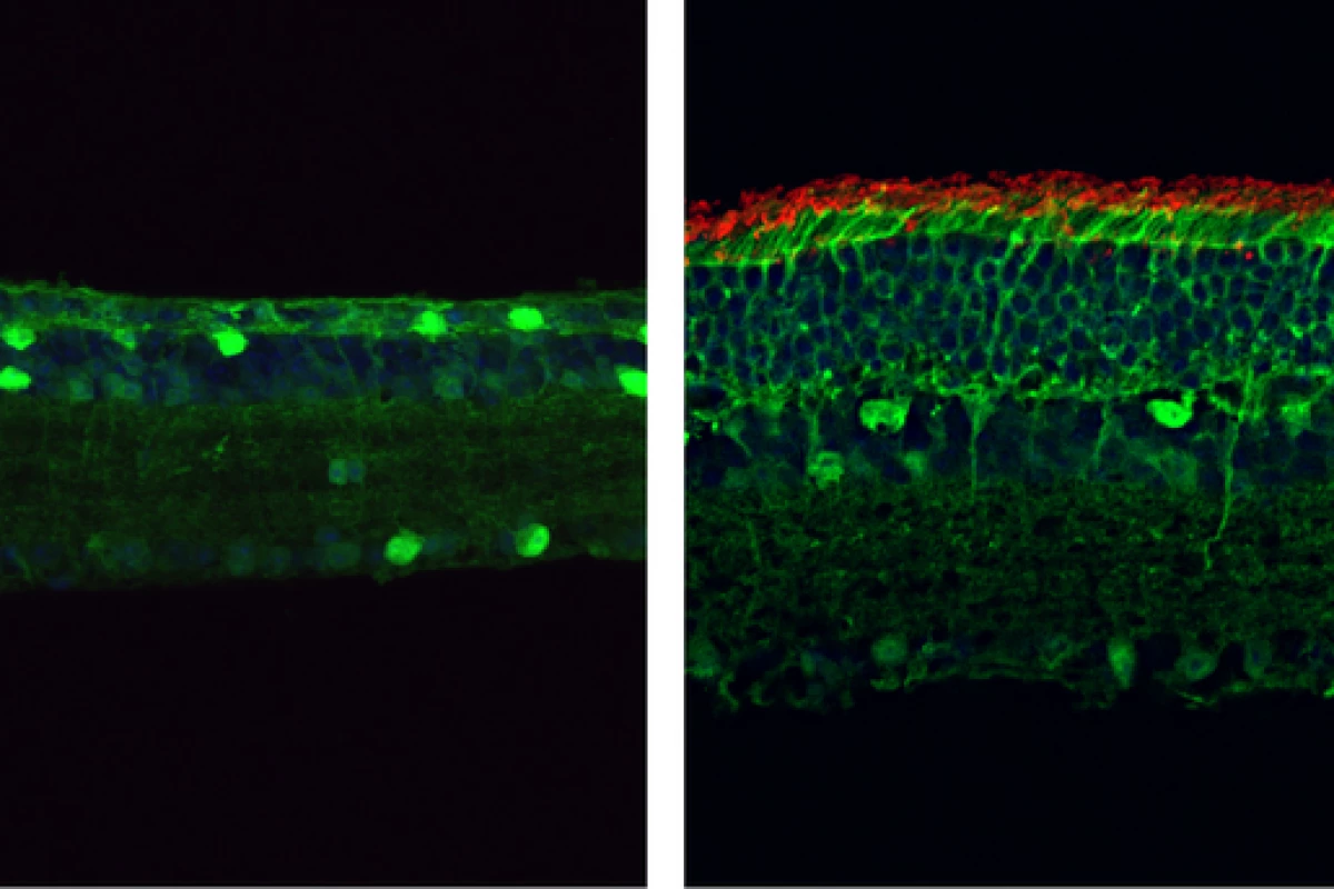 The image on the left shows a lack of rod photoreceptors due to retinitis pigmentosa – the image on the right shows a thicker retina with more rod cells (shown in red) after a genetic mutation was corrected with a new gene-editing system called PESpRY.