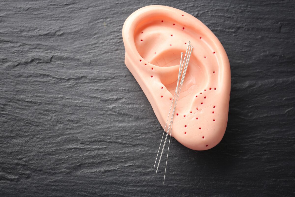 Migraine pain drops after targeted ear acupuncture