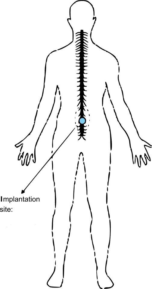 The implant site on the spinal canal