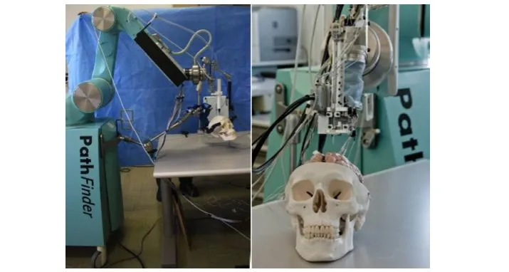 The ROBOCAST Project is developing a robotic system for assisting with keyhole neurosurgery