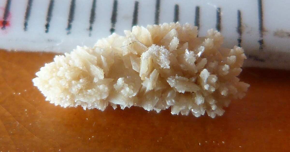 蠕动磁控微型机器人攻克肾结石