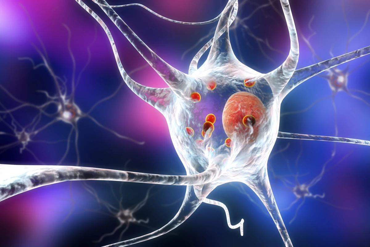 Researchers have discovered how Parkinson's disease-causing proteins spread in the brain