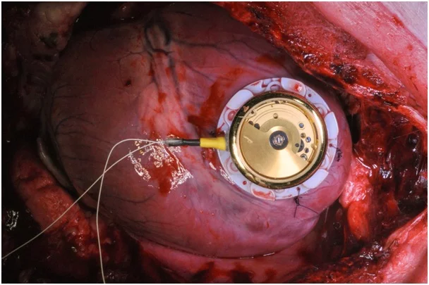 The energy-harvesting device, attached to a pig's heart