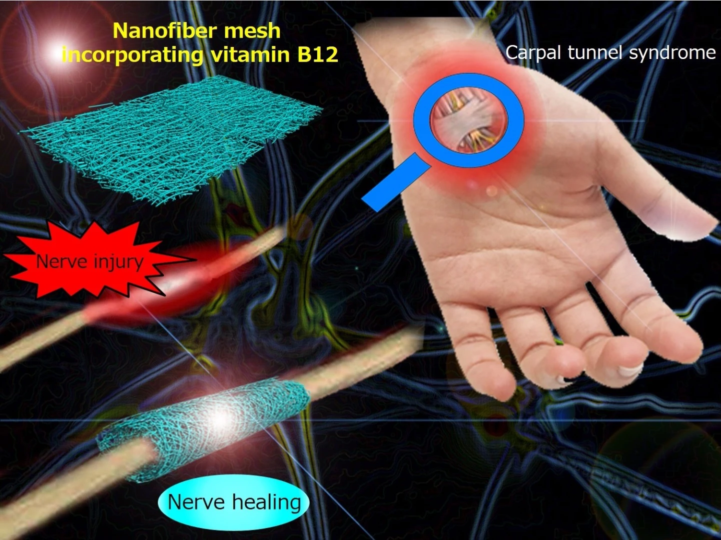 The mesh takes the form of a flat sheet that is surgically wrapped around the injured nerve to form a sleeve