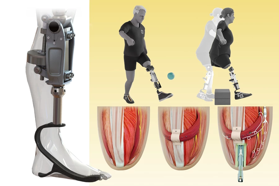 The new bionic knee is directly integrated with the user’s muscle and bone tissue (bottom row right), allowing for faster and more fluid motion than with a traditional prosthesis.